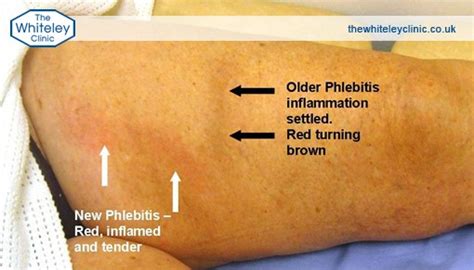 plebitas|Phlebitis Treatment & Symptoms .